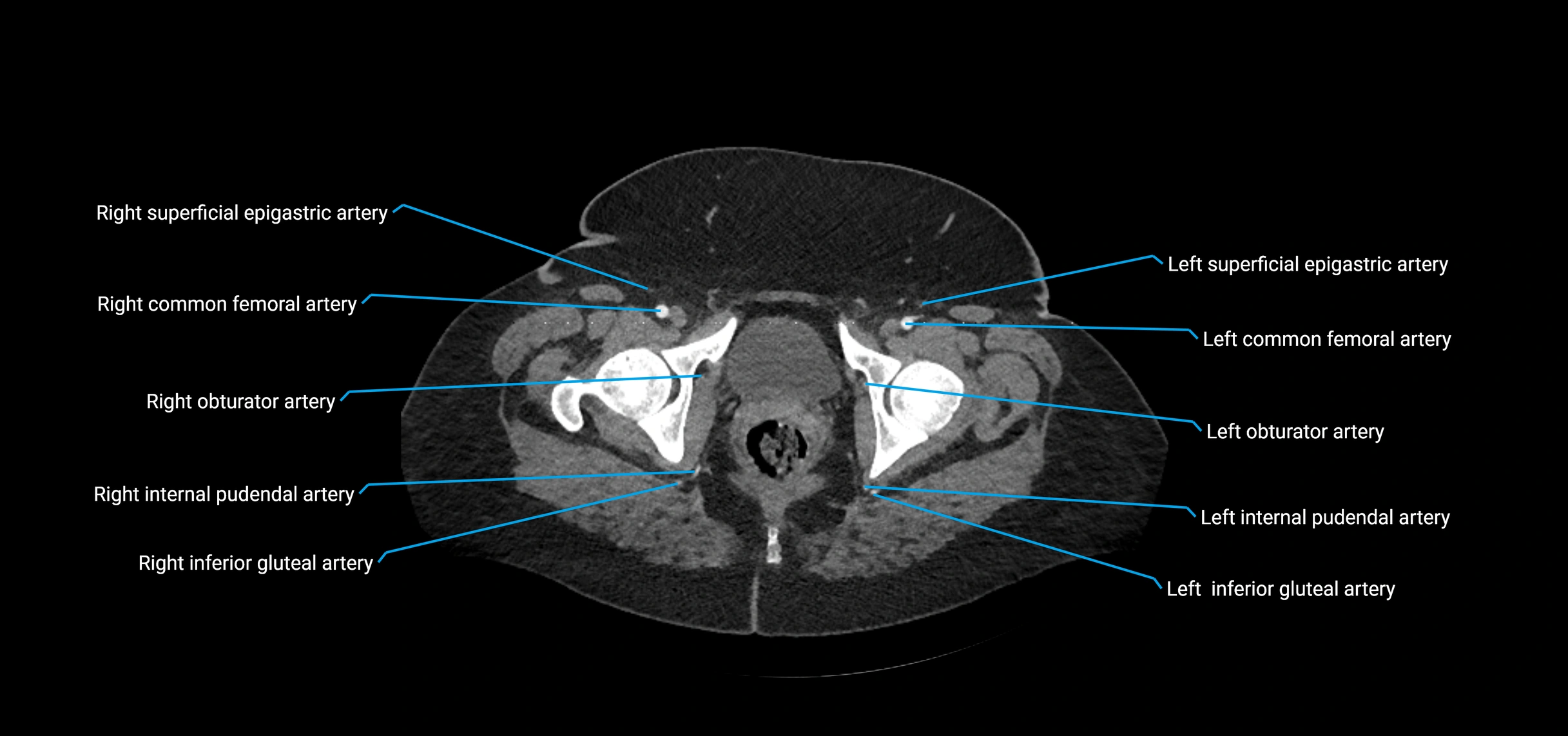 CTA abdomen axial cross sectional anatomy labelled image_251 (2).webp